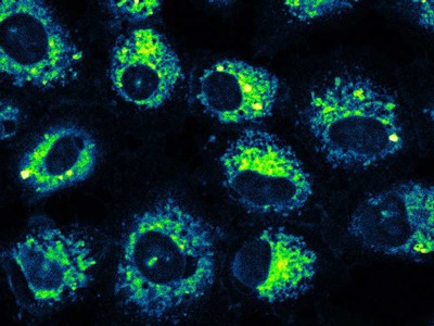 Human lung cancer cells